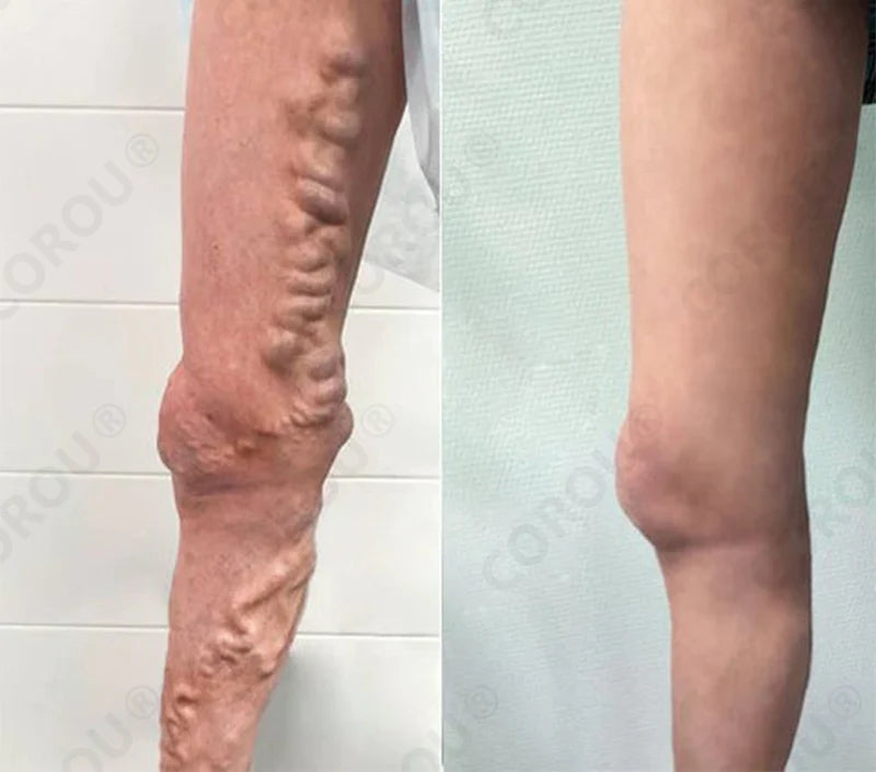 COROU® Natural Herbal Tourmaline Far Infrared Foot Patches 20 gempages 567118433360020521 df4c420e 38cb 4b91 ba2c d7875cd9f359